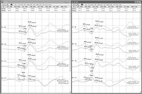 Example of VEP recordings. | Download Scientific Diagram