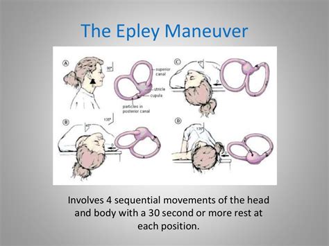 Benign Paroxysmal Positional Vertigo Bppv