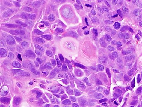 Esophageal Squamous Cell Carcinoma Histology