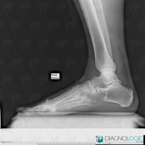 Radiology Case Stress Fracture X Rays Diagnologic