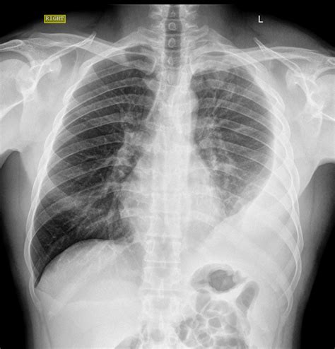 Derrame Pleural Entenda O Quadro Cirurgia Torácica Do Vale