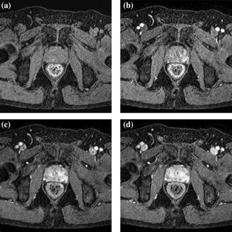 Sffssvm Based Prostate Carcinoma Diagnosis In Dce Mri Via Acm