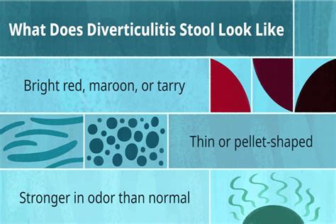 Best 6 steps what does poop look like with diverticulitis - iggram.com