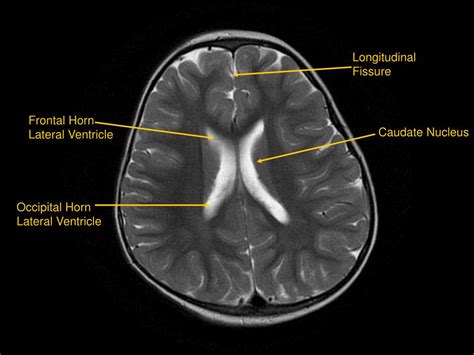 Ppt Mri Of Brainhead And Neck Powerpoint Presentation Free Download