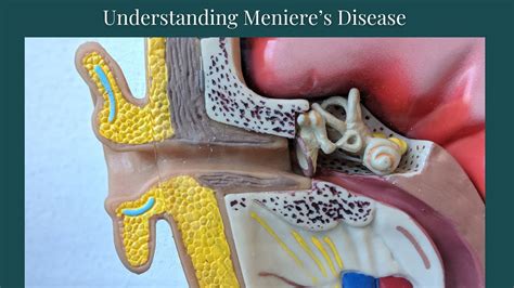 Meniere S Disease Made Simple Explained By A Physical Therapist YouTube