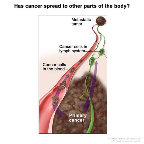 Melanoma | Vanderbilt-Ingram Cancer Center