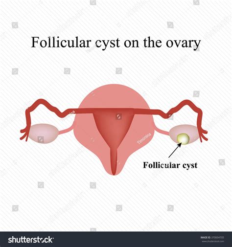 Follicular Ovarian Cyst Functional Cyst Royalty Free Stock Vector