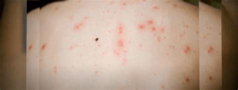 How Are Shingles Virus Triggered? - The Viral Inhibitor