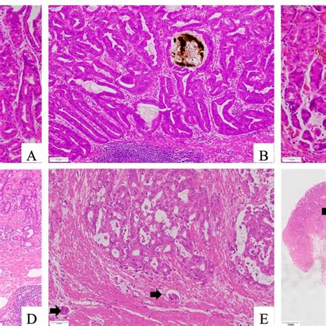 Histopathological Features Of Fundic Gland Neoplasm A Oxyntic Gland