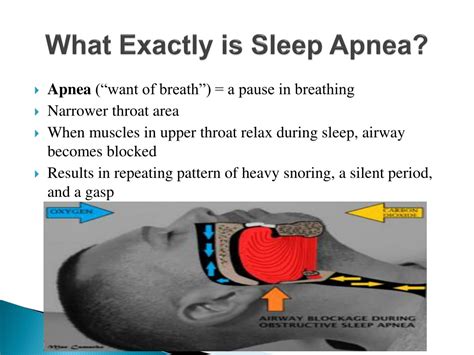 Ppt Sleep Apnea Powerpoint Presentation Free Download Id 9424430