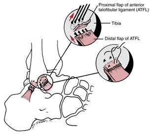 Ankle Arthroscopy And Ankle Ligament Reconstruction Murdoch