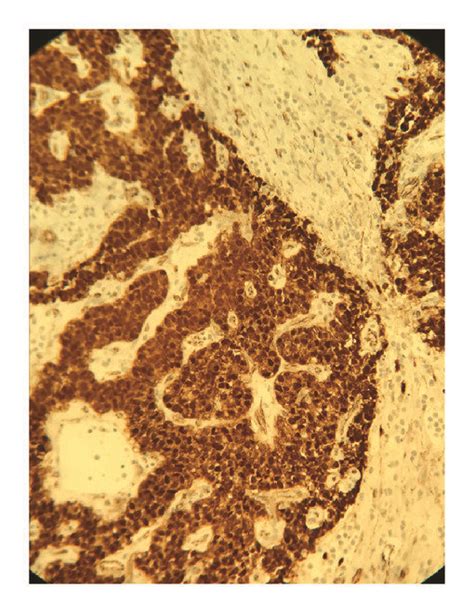 Immunohistochemical Staining Shows Nuclear Positivity For Beta Catenin Download Scientific