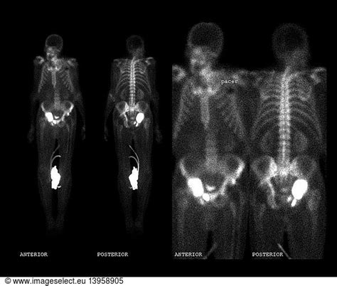 pelvic fractures pelvic fractures bone scanabnormal bone scan