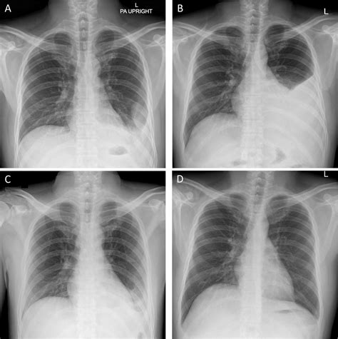 Hemothorax X Ray