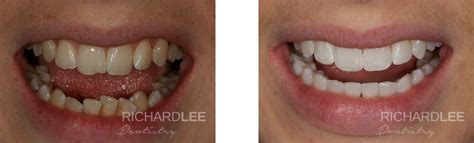Crooked Bottom Teeth