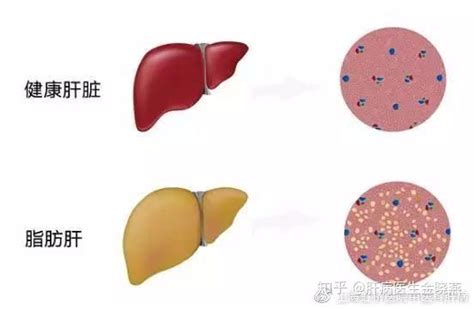 揭秘：脂肪肝有多严重，到底需不需治疗？ 知乎