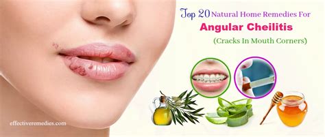 20 Home Remedies For Angular Cheilitis (Cracks In Mouth Corners)