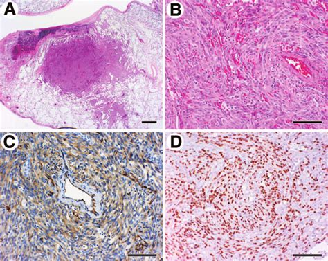 Histologic Examination Of Kaposis Sarcoma From Lung Transplant