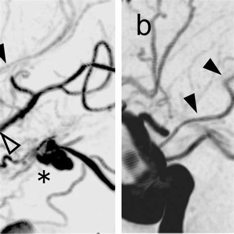 Perforating branches of the anterior choroidal artery (AChA) visualized ...