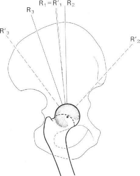 Figure 4 from The thickness of the cartilage in the hip joint ...