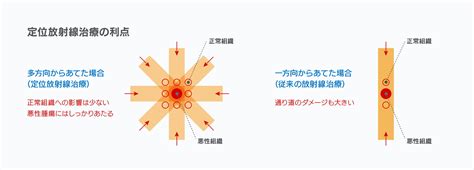 リニアック 放射線治療 がん診療 済生会熊本病院