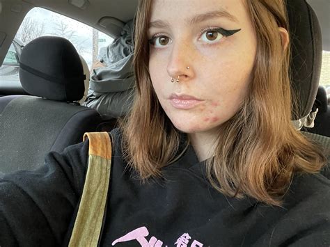 22f, i’ve had hormonal acne for about a decade now. I’ve talked to