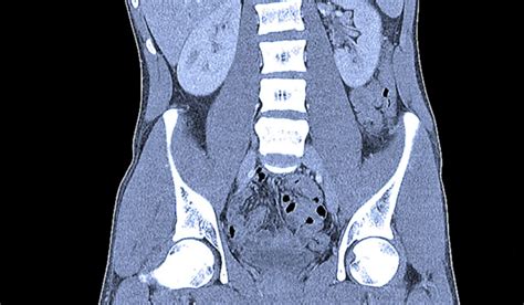 ct scan contrast dangerous heres      ct scan