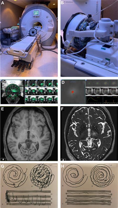High-Frequency Ultrasound Ablation in Neurosurgery - Neurosurgery Clinics