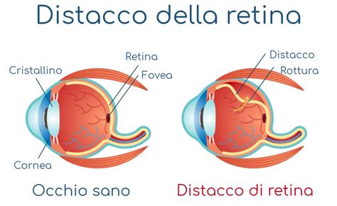 Distacco Della Retina Sintomi Cause E Cura Blog Di Clinica Baviera