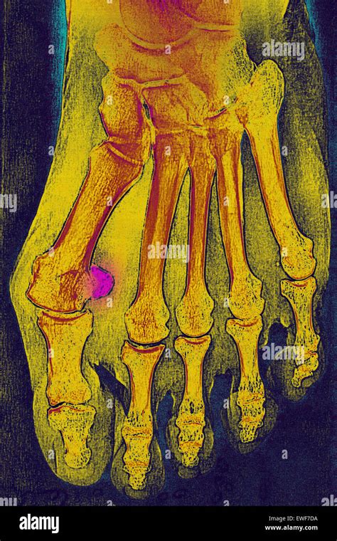 Hallux Valgus X Ray Stock Photo Alamy
