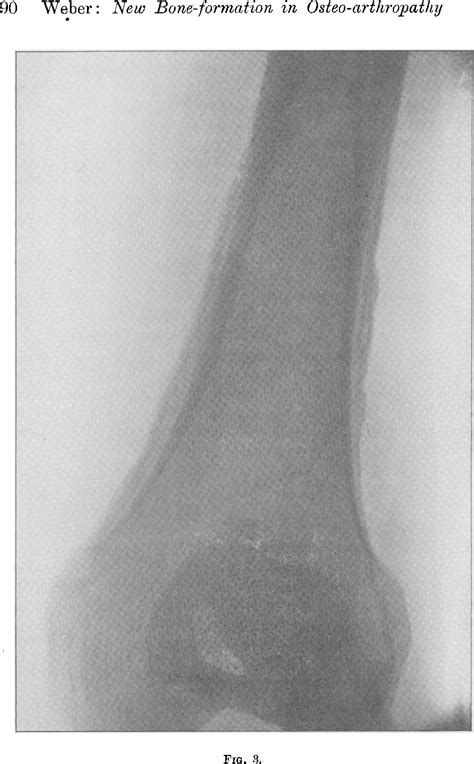 Figure 3 From The Histology Of The New Bone Formation In A Case Of