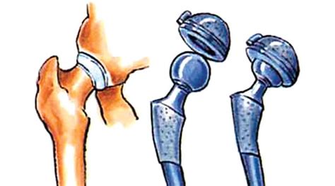 Chart stik label эндопротез фото и описание