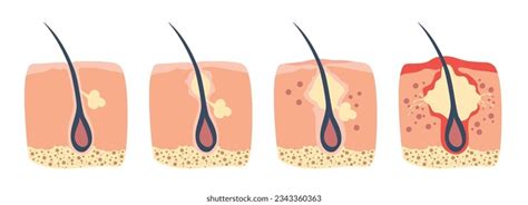 Acne Inflammed Pustule Follicle Bacteria: Over 53 Royalty-Free ...