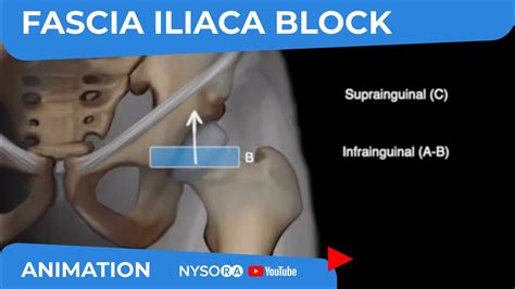 Scanning Principles For Infrainguinal Vs Suprainguinal Fascia Iliaca