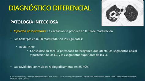 Lesiones Pulmonares Cavitadas Ppt