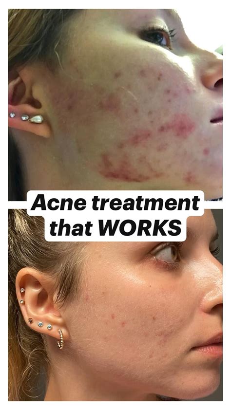 How To Get Rid Of Acne Overnight 12 Remedies That Work Artofit