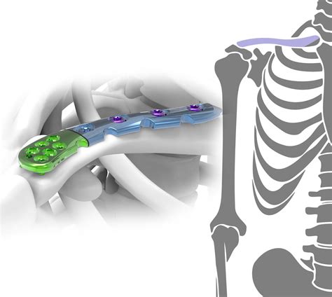 Clavicle 2,7 / 3,5mm - Astrolabe