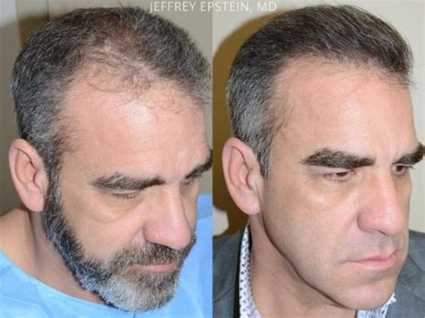 Hair Transplants For Men Photos Miami Fl Patient54176