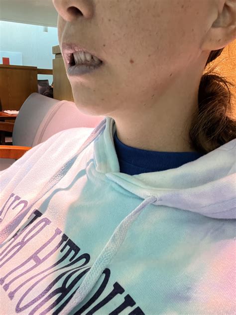 Three Week Appointment And Bottom Lip Seems Very Far Down Rjawsurgery