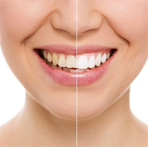 Beautiful Smiles Cosmetic Dentistry In Gresham Dr Jeremy Archibald