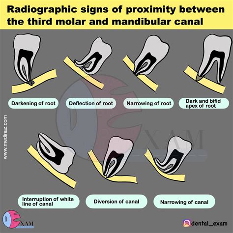 Dental Exam - Radiographic signs of proximity between the 3rd molar and