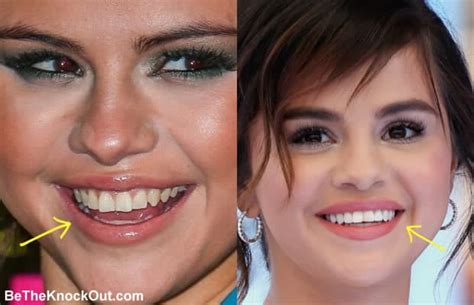 Selena Gomez Plastic Surgery Comparison Photos