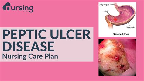 What Is Peptic Ulcer Disease And How To Care For It Nursing Care