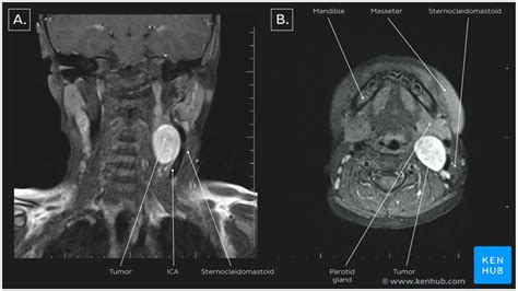 Horner S Syndrome Clinical Case And Images Kenhub