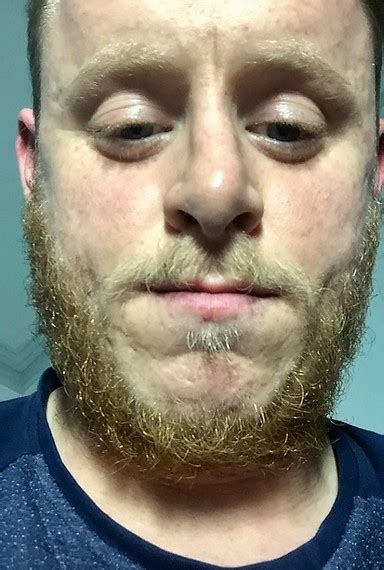 24 Y O First Attempt Blonde Red Beard Update Page 2 Beard Board