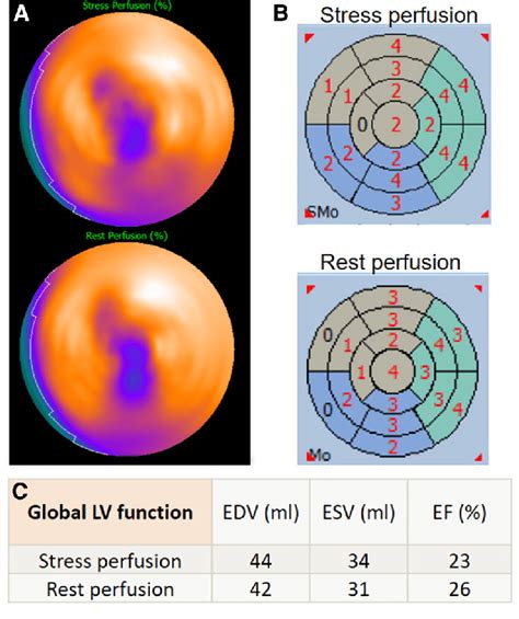 A Myocardial Perfusion Polar Maps For Stress Top And Rest Bottom