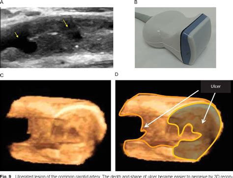 Figure 9 From Carotid Artery Plaque Diagnosis Ultrasound Diagnosis Of Carotid Plaques Semantic