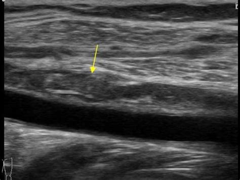 Peripheral vessels | 10.2 Peripheral veins : Case 10.2.2 Deep venous ...