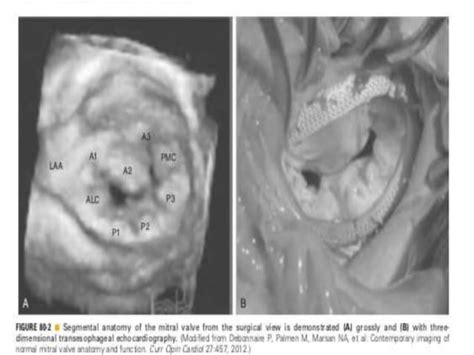 Mitral Valve Anatomy Ppt