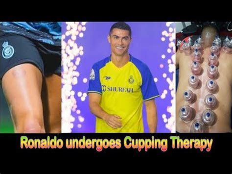 Cristiano Ronaldo Undergoes Cupping Therapy Al Nasr Football Club Youtube